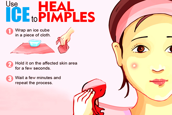 Natural Remedies For Pimples