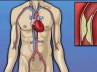 bypass, bypass, revolutionary heart surgery with 10 grafts, Heart surgery