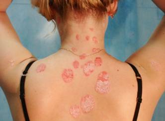 Causes for Psoriasis...