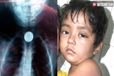 SSKM hospitals, SSKM hospitals, child refused by four hospitals after coin stucks in his throat, Stuck