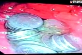 63 coins man stomach new updates, 63 coins man stomach news, 63 coins recovered from a man s stomach in jodhpur, Stomach