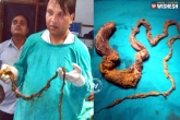 viral videos, UP, five foot hairball found in the stomach, Hairball