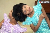 government, Veena-Vani, niloufer hospital asks govt to decide on conjoined twins, Niloufer hospital