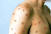 Monkeypox spread, Monkeypox in India, india confirms its second monkeypox case, Kerala