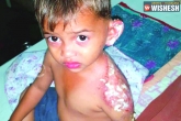 investigation, ablaze, minor boy sets ablaze 3 year old kid for not giving way, Balala hakkula sangham