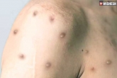 Monkeypox WHO, Monkeypox WHO, monkeypox found in semen and is sexually transmitted, Study