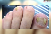 Nail fungal infections prevention, Nail fungal infections breaking updates, all about nail fungus and why nails turn yellow, Tips