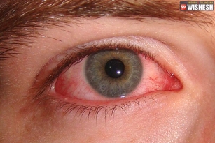Pink Eyes, The Primary Symptom Of Coronavirus