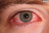 Pink eyes news, Pink eyes symptoms, pink eyes the primary symptom of coronavirus, Mary
