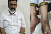 Raghu Rama Krishnam Raju arrest, Raghu Rama Krishnam Raju updates, raghu rama krishnam raju s legs fractured says medical report, Supreme court