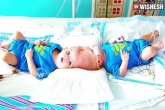 New York, Conjoined twins, rare conjoined twin boys undergo surgery seperated after 27 hrs, Conjoined twins