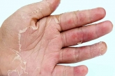 Skin Peeling on Hands, Skin Peeling on Hands causes, five causes of skin peeling on hands, Care