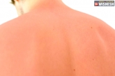 Sunburn summer, Sunburn latest, tips and treatment for sunburn, Beauty