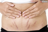 Tips to lighten stretch marks, Here is the way to lighten your stretch marks, tips to lighten stretch marks, Naturally