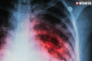 All about Tuberculosis and its Treatment