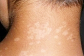 White Patches On Skin news, White Patches On Skin tips, what are the indications white patches on skin, Care