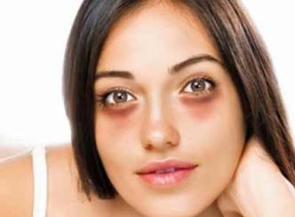 Home remedies to cure dark circles...!