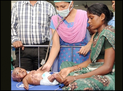 Boy catches fire on his own