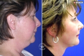 fat neck exercises, food to eat for reducing fatness in neck, is your neck fat here s the solution, Neck