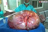 woman stomach tumour, weird news, 95kg tumour in woman s stomach removed in up, Weird news