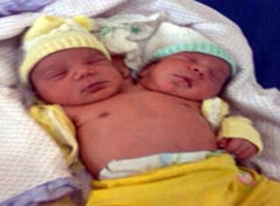 A Brazilian woman give birth to a two-headed baby boy