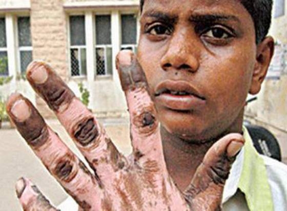 Teenage boy&#039;s hand immersed in boiling oil