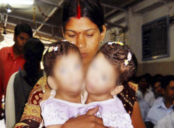 Conjoined twins separated in MP