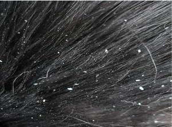 Dandruff... a skin disease???